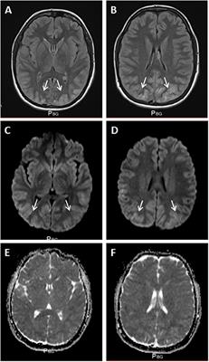 Posterior Reversible Encephalopathy Syndrome After Self-Medication With an Oral Decongestant: A Case Report